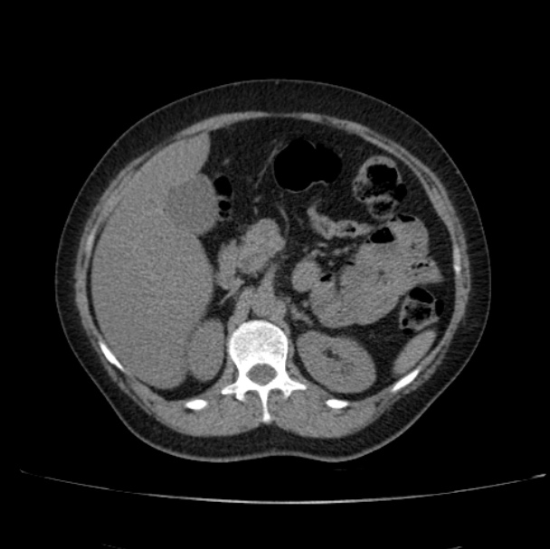 Axial non-contrast CT image
